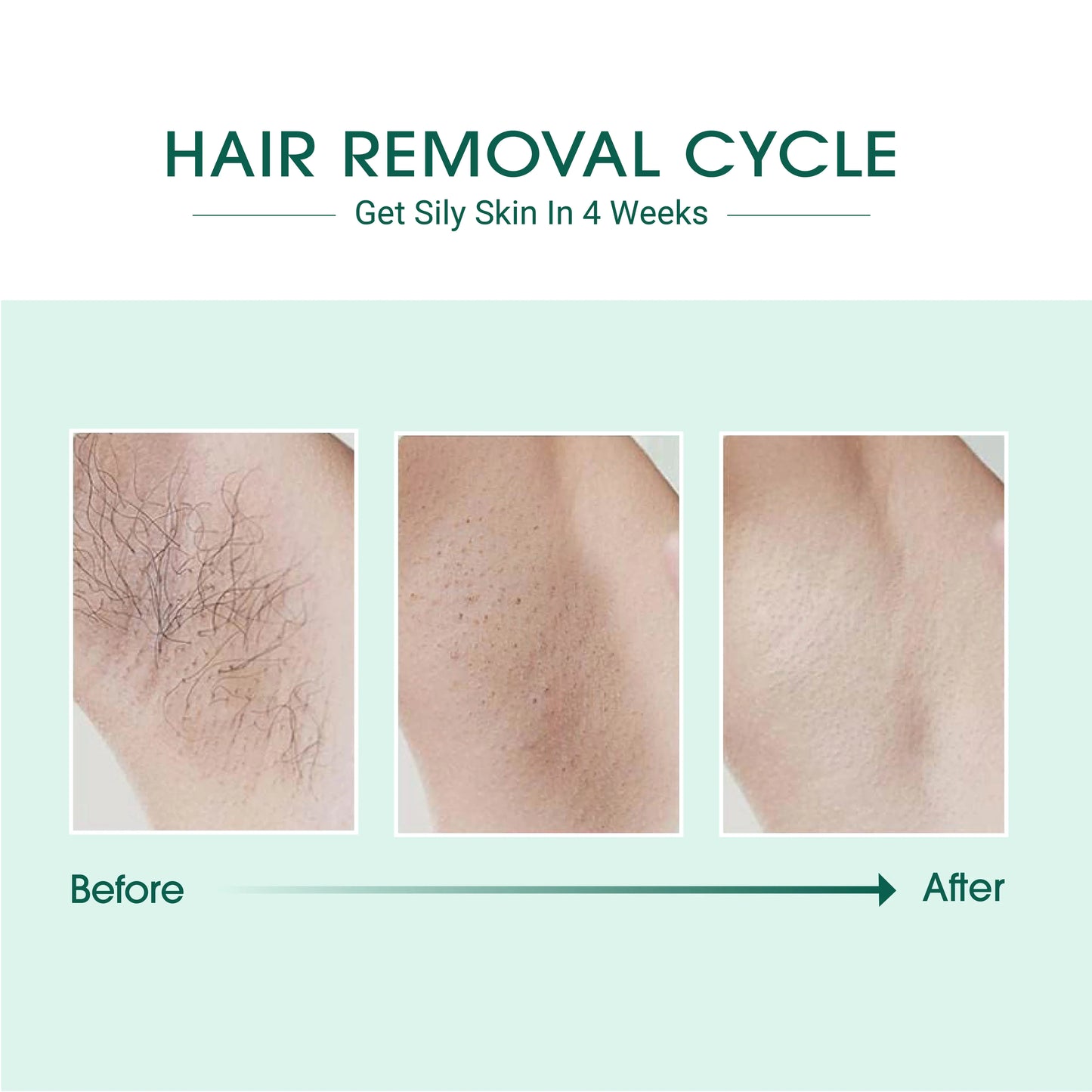 Laser IPL Hair Removal